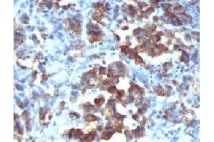 Formalin-fixed, paraffin-embedded human gastric carcinoma stained with Cdc20 antibody (CDC20/1102)