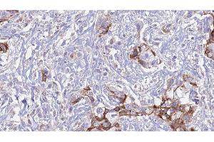 ABIN6277587 at 1/100 staining Human urothelial cancer tissue by IHC-P. (MERTK antibody  (Internal Region))