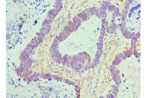 Immunohistochemistry of paraffin-embedded human ovarian cancer using ABIN7172779 at dilution of 1:100 (CTCF antibody  (AA 1-260))