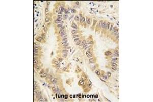 Formalin-fixed and paraffin-embedded human lung carcinoma tissue reacted with SOD2 Monoclonal Antibody (ABIN387807 and ABIN2843901) , which was peroxidase-conjugated to the secondary antibody, followed by DAB staining. (SOD2 antibody)