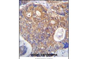 ICS Antibody (N-term) (ABIN656869 and ABIN2846073) immunohistochemistry analysis in formalin fixed and raffin embedded human colon carcinoma followed by peroxidase conjugation of the secondary antibody and DAB staining. (PAICS antibody  (N-Term))