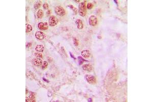 Immunohistochemical analysis of hnRNP A1 staining in human lung cancer formalin fixed paraffin embedded tissue section. (HNRNPA1 antibody  (Center))