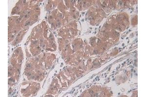 DAB staining on IHC-P; Samples: Human Glioma Tissue) (PAI1 antibody  (AA 25-402))