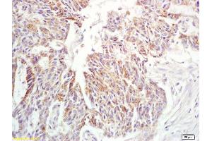 Formalin-fixed and paraffin embedded human rectal carcinoma labeled with Anti-IL-6 Polyclonal Antibody, Unconjugated (ABIN872547) at 1:200 followed by conjugation to the secondary antibody and DAB staining (IL-6 antibody  (AA 51-150))