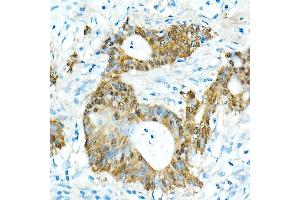 Immunohistochemistry of paraffin-embedded Human colon carcinoma using CDX2 antibody  at dilution of 1:300 (40x lens). (CDX2 antibody)