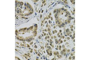 Immunohistochemistry of paraffin-embedded human breast cancer using EBAG9 Antibody (ABIN1872406) at dilution of 1:100 (40x lens). (RCAS1 antibody)