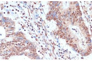 Immunohistochemistry of paraffin-embedded Human colon carcinoma using NAA20 Polyclonal Antibody at dilution of 1:100 (40x lens).