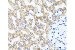 Immunohistochemistry of paraffin-embedded Human liver damage using RIPK4 Polyclonal Antibody at dilution of 1:100 (40x lens). (RIPK4 antibody)