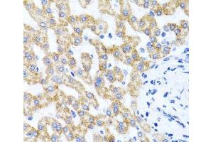 Immunohistochemistry of paraffin-embedded Human liver damage using RIPK4 Polyclonal Antibody at dilution of 1:100 (40x lens).