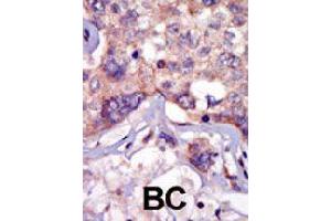 Formalin-fixed and paraffin-embedded human cancer tissue reacted with LCK polyclonal antibody  , which was peroxidase-conjugated to the secondary antibody, followed by AEC staining. (LCK antibody  (N-Term))