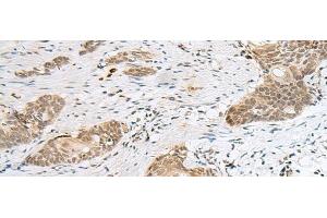 Immunohistochemistry of paraffin-embedded Human esophagus cancer tissue using CALCOCO1 Polyclonal Antibody at dilution of 1:50(x200) (CALCOCO1 antibody)