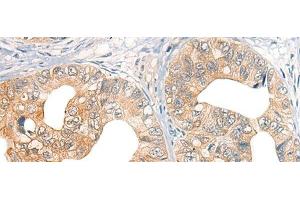 Immunohistochemistry of paraffin-embedded Human gastric cancer tissue using CORO2A Polyclonal Antibody at dilution of 1:45(x200) (CORO2A antibody)