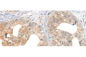 Immunohistochemistry of paraffin-embedded Human gastric cancer tissue using CORO2A Polyclonal Antibody at dilution of 1:45(x200) (CORO2A antibody)