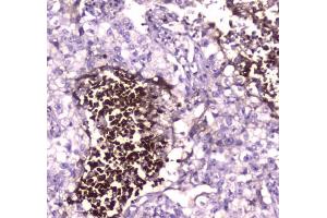 IHC testing of FFPE human lung cancer tissue with Lactoferrin antibody at 1ug/ml.