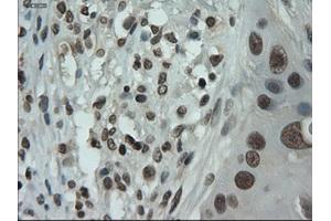 Immunohistochemical staining of paraffin-embedded Adenocarcinoma of breast using anti-IL-3 (ABIN2452543) mouse monoclonal antibody. (IL-3 antibody  (AA 20-152))
