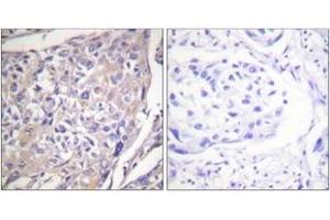 Immunohistochemistry analysis of paraffin-embedded human breast carcinoma, using p70 S6 Kinase (Phospho-Ser418) Antibody.