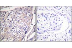 Immunohistochemistry analysis of paraffin-embedded human breast carcinoma, using p70 S6 Kinase (Phospho-Ser418) Antibody. (RPS6KB1 antibody  (pSer418))