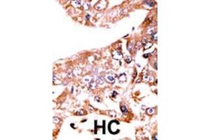 Formalin-fixed and paraffin-embedded human cancer tissue reacted with the primary antibody, which was peroxidase-conjugated to the secondary antibody, followed by AEC staining. (STAT1 antibody  (pSer727))