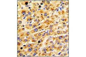 Immunohistochemistry: ADAMTS13 antibody staining of Formalin-Fixed Paraffin-Embedded Human hepatocarcinoma followed by peroxidase-conjugation to the secondary antibody and DAB staining. (ADAMTS13 antibody  (AA 836-866))