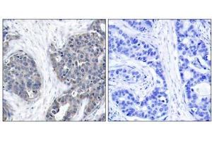 Immunohistochemical analysis of paraffin-embedded human breast carcinoma tissue using Stathmin 1 (Ab-37) antibody (E021218). (Stathmin 1 antibody)