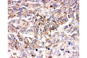 IHC-P: SMAD1 antibody testing of human lung cancer tissue