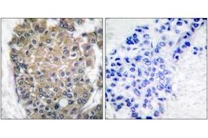 Immunohistochemistry analysis of paraffin-embedded human breast carcinoma tissue, using Keratin 17 Antibody. (KRT17 antibody  (AA 381-430))