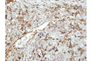 IHC-P Image Immunohistochemical analysis of paraffin-embedded CL1-0 xenograft, using GK5, antibody at 1:500 dilution. (GK5 antibody  (Center))