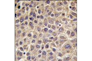 Formalin-fixed and paraffin-embedded human hepatocarcinoma tissue reacted with MTMR8 antibody (C-term), which was peroxidase-conjugated to the secondary antibody, followed by DAB staining. (MTMR8 antibody  (C-Term))