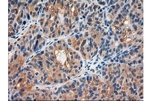 Immunohistochemical staining of paraffin-embedded Carcinoma of kidney using anti-AMY2A (ABIN2452539) mouse monoclonal antibody. (AMY2A antibody  (AA 300-511))