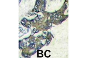 IHC analysis of formalin-fixed and paraffin-embedded human breast carcinoma tissue reacted with MAPK1 Antibody, which was peroxidase-conjugated to the secondary antibody, followed by DAB staining. (ERK2 antibody  (C-Term))