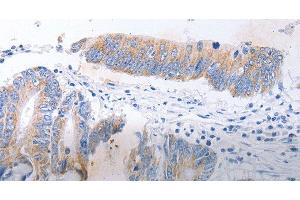 Immunohistochemistry of paraffin-embedded Human colon cancer tissue using SERP1 Polyclonal Antibody at dilution 1:30 (SERP1 antibody)