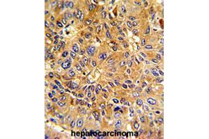 Formalin-fixed and paraffin-embedded human hepatocarcinomareacted with CCNA2 polyclonal antibody , which was peroxidase-conjugated to the secondary antibody, followed by AEC staining. (Cyclin A antibody  (N-Term))