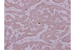 IHC-P Image PCYT2 antibody detects PCYT2 protein at cytoplasm on human breast cancer by immunohistochemical analysis.