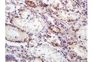 Formalin-fixed and paraffin embedded human colon carcinoma labeled with Anti-CEAcam8 Polyclonal Antibody, Unconjugated (ABIN672651) at 1:200 followed by conjugation to the secondary antibody and DAB staining