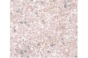 IHC-P analysis of Human Glioma Tissue, with DAB staining.