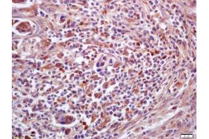 Formalin-fixed and paraffin embedded human lung carcinoma labeled with Anti-PPT1 Polyclonal Antibody, Unconjugated (ABIN718946) at 1:200 followed by conjugation to the secondary antibody and DAB staining (PPT1 antibody  (AA 188-290))