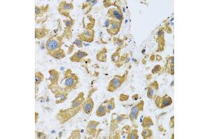 Immunohistochemistry of paraffin-embedded human liver cancer using BTD antibody (ABIN5973709) at dilution of 1/100 (40x lens). (BTD antibody)