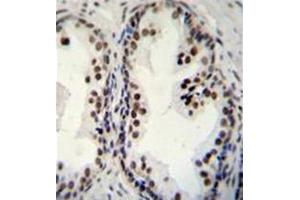 Formalin fixed and paraffin embedded human prsotate carcinoma stained with DDX27 Antibody (C-term) Cat. (DDX27 antibody  (C-Term))