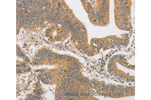 Immunohistochemistry of Human liver cancer using ARHGAP15 Polyclonal Antibody at dilution of 1:30