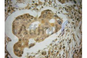 ABIN6267585 at 1/100 staining human breast carcinoma tissues sections by IHC-P. (MDM2 antibody  (pSer166))