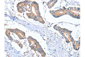 The image on the left is immunohistochemistry of paraffin-embedded Human colon cancer tissue using ABIN7130296(MTMR7 Antibody) at dilution 1/40, on the right is treated with fusion protein. (MTMR7 antibody)