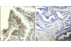 Immunohistochemical analysis of paraffin-embedded human colon carcinoma tissue using CDK6 (Ab-13) Antibody (E021542). (CDK6 antibody)