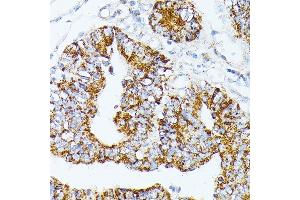 Immunohistochemistry of paraffin-embedded Human colon carcinoma using TR antibody (ABIN1683134, ABIN5664756, ABIN5664758 and ABIN6220605) at dilution of 1:100 (40x lens). (TRAP1 antibody  (AA 445-704))