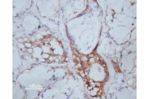 ABIN6266591 at 1/200 staining human Oral squamous cell carcinoma sections by IHC-P. (MMP14 antibody  (C-Term))