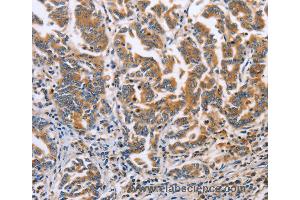 Immunohistochemistry of Human liver cancer using DOK4 Polyclonal Antibody at dilution of 1:60 (DOK4 antibody)