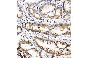 Anti-Oncostatin M antibody, IHC(P) IHC(P):Human Intestinal Cancer Tissue