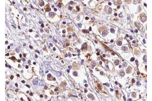 ABIN6273603 at 1/100 staining Human breast cancer tissue by IHC-P. (SLC35C2 antibody  (C-Term))