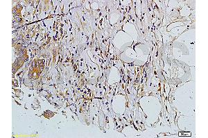 Formalin-fixed and paraffin embedded human colon carcinoma labeled with Rabbit Anti-MMP-7 Polyclonal Antibody, Unconjugated (ABIN668451) at 1:200 followed by conjugation to the secondary antibody and DAB staining. (MMP7 antibody  (AA 151-250))