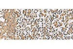 Immunohistochemistry of paraffin-embedded Human tonsil tissue using DCAF12 Polyclonal Antibody at dilution of 1:65(x200)