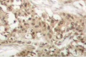 Immunohistochemistry (IHC) analyzes of p-PKC theta antibody in paraffin-embedded human breast carcinoma tissue. (PKC theta antibody  (pSer676))